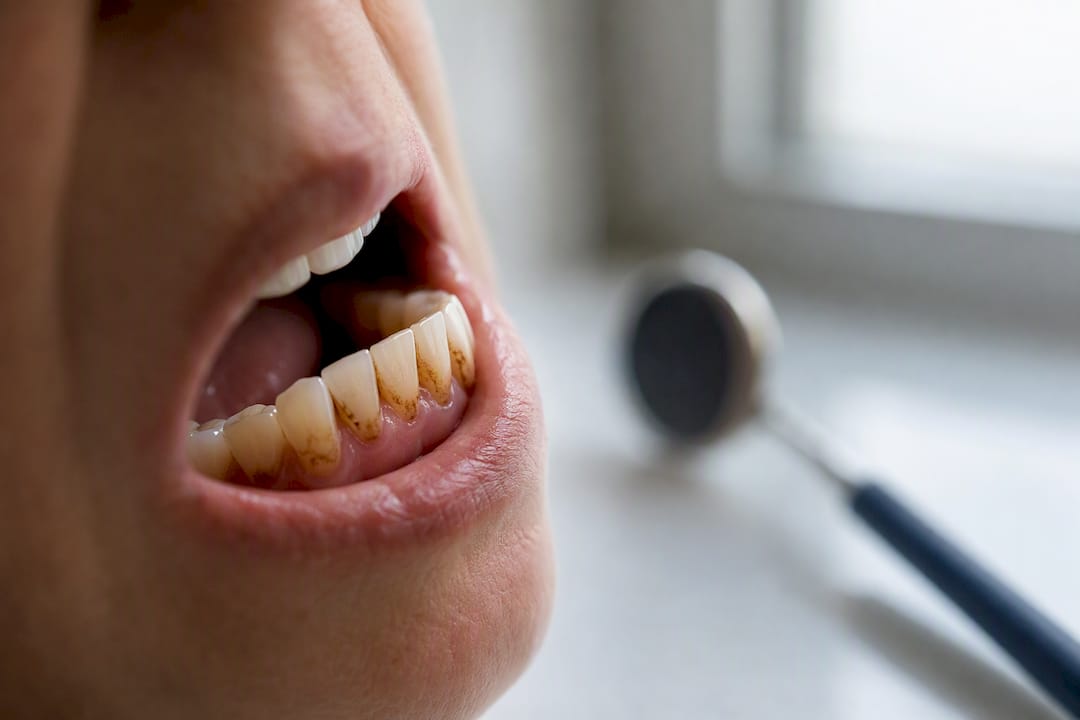 Close-up of stained teeth before whitening