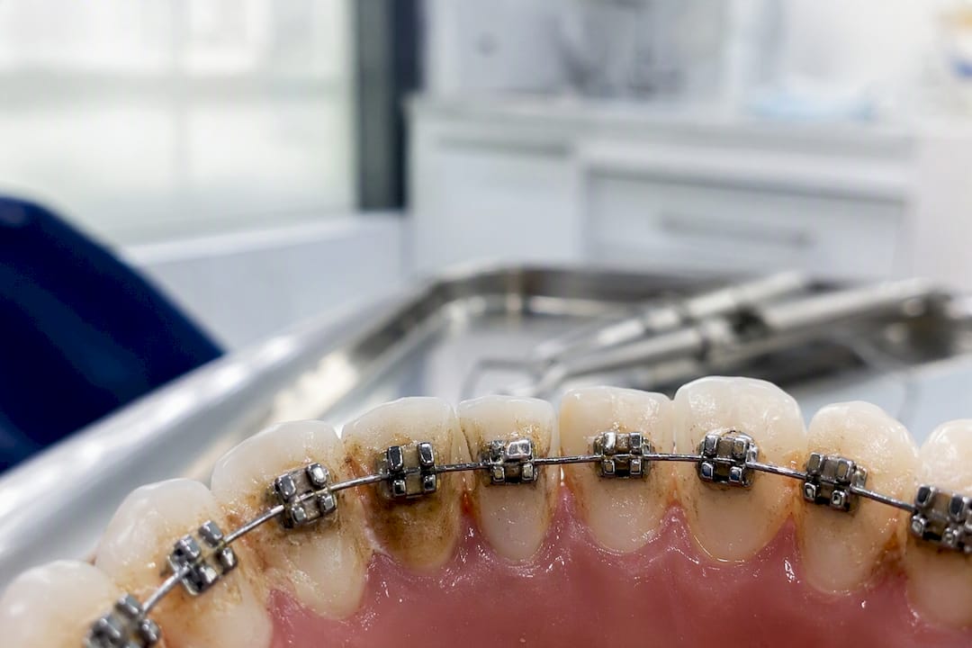 Close-up of braces showing plaque and tartar buildup