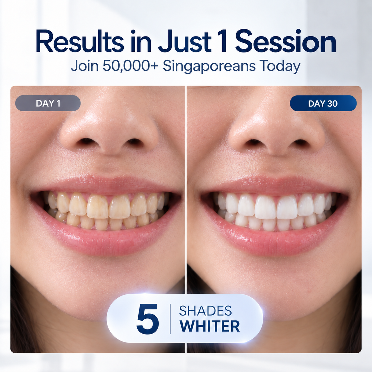 K-Smile™ Whitening Kit - Whiter Teeth In 15 Minutes! v2